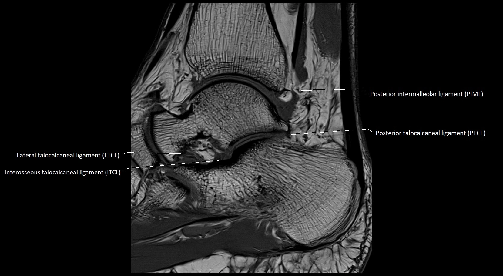 MRI ankle ligaments anatomy sagittal 3T image 14.webp